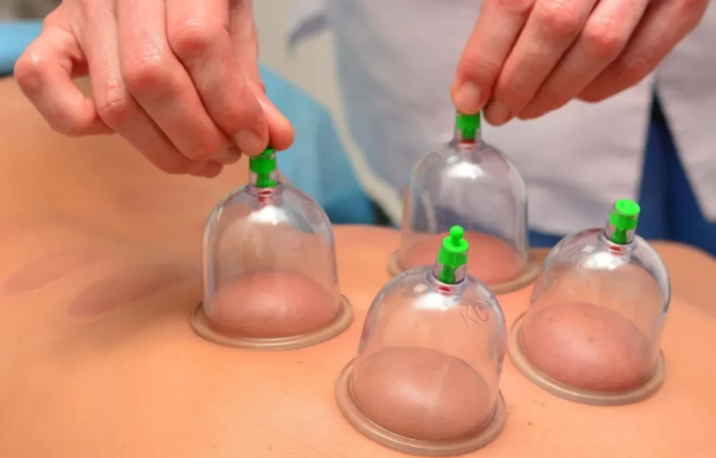 Masaje con ventosas